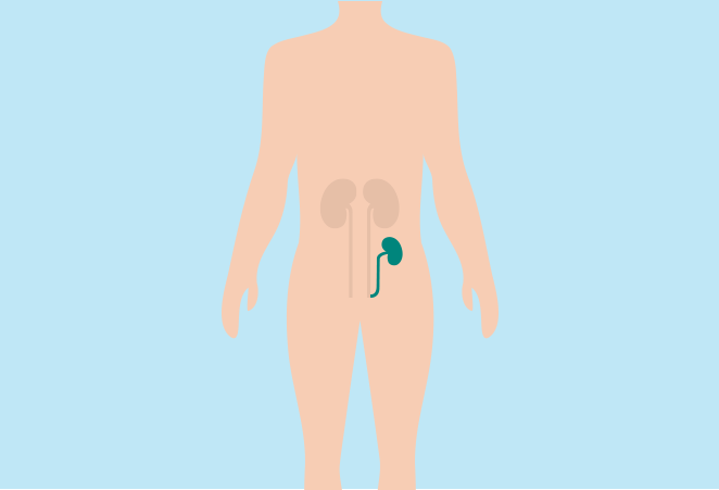 O que é um transplante renal